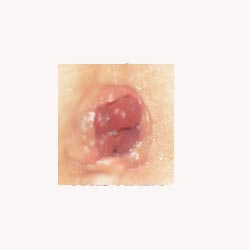 Hemorrhoid Mix