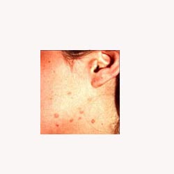 Wart Mix