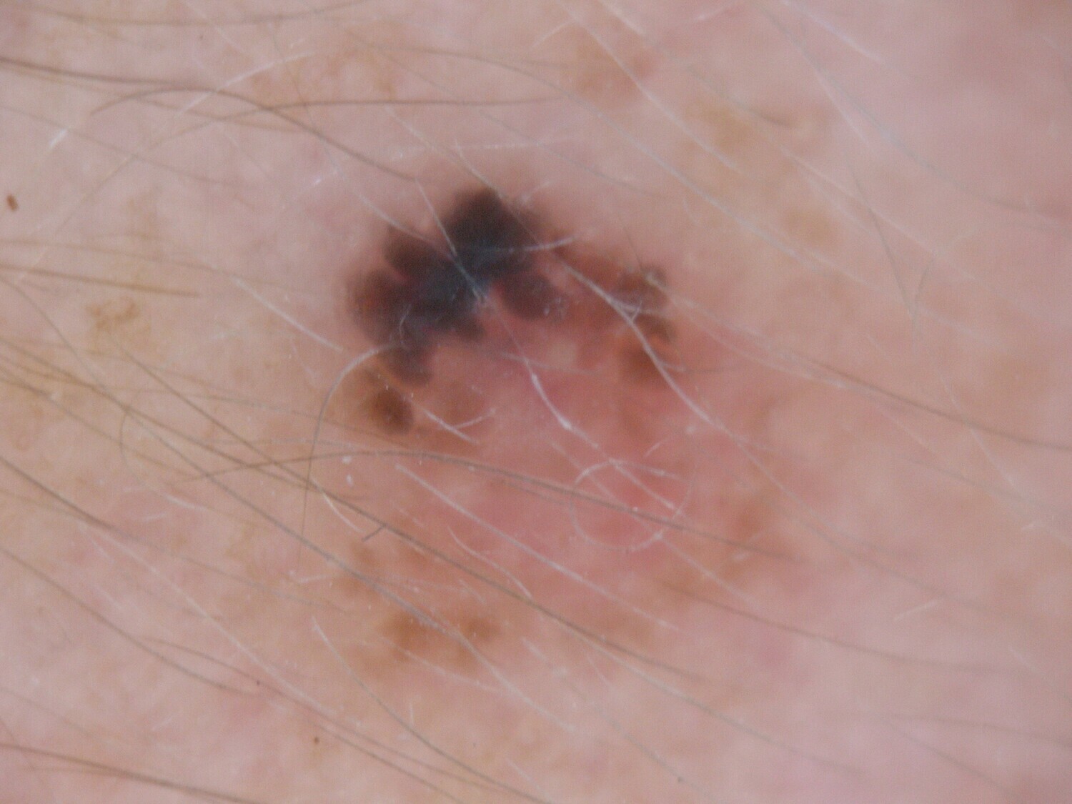 Consulta de Teledermatología
