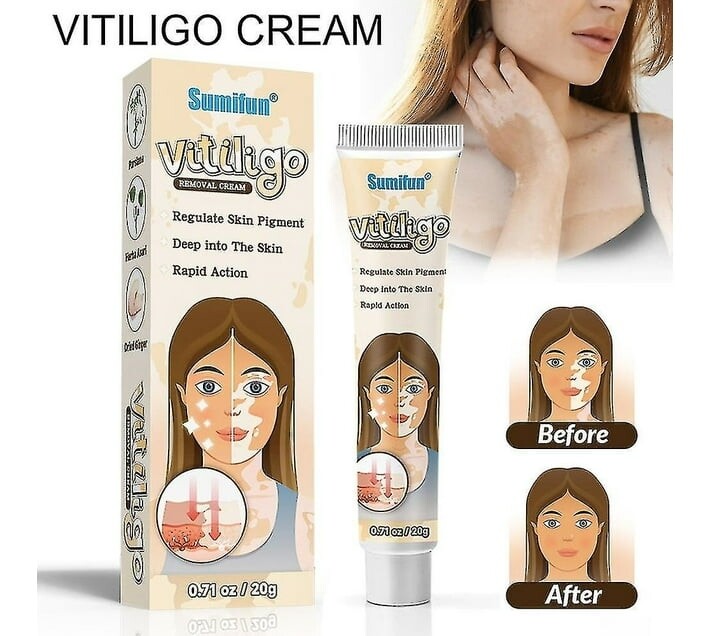 Vitiligo Removal Cream