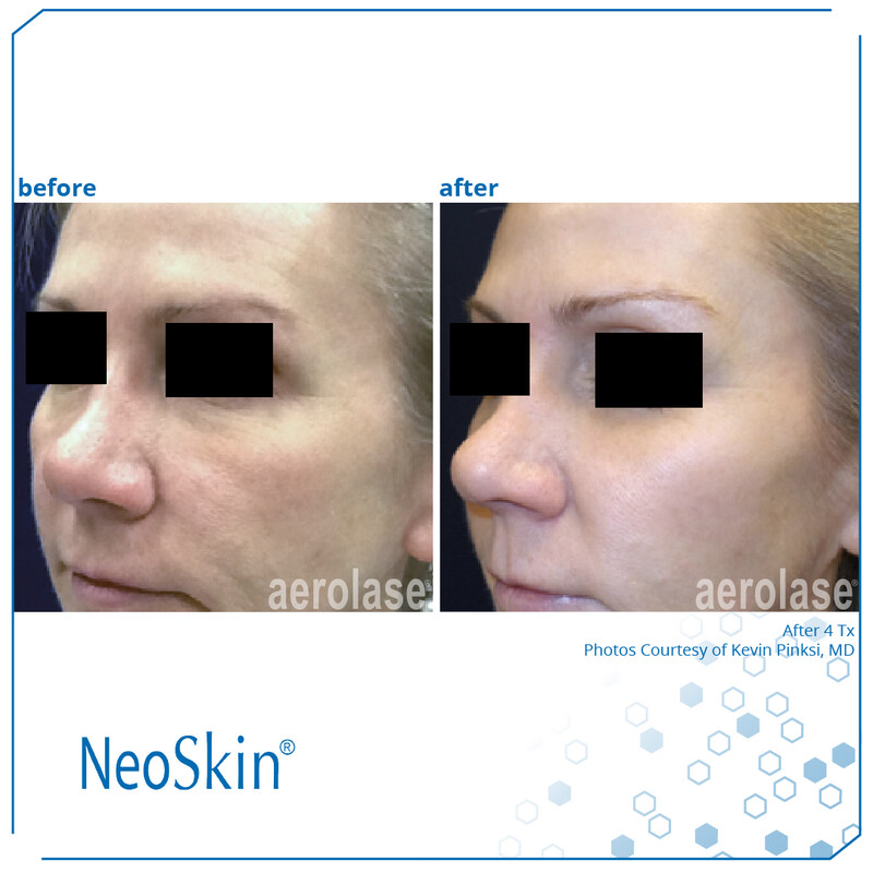 AEROLASE SKIN REJUVENATION -  4 TREATMENTS FOR FACE