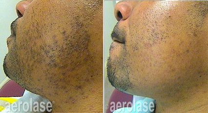 AEROLASE PSEUDOFOLLITIS BARBAE TREATMENT- 6 TREAMENTS PACKAGE