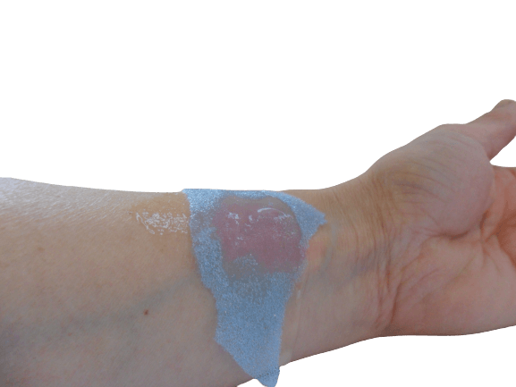 Brännskadegel, flaska 59ml gel m fixérkompress