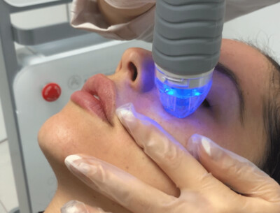 Virtue RF Micro-Needling Rejuvenation Treatment Virtue RF Micro-Needling Rejuvenation Treatment