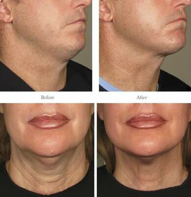 Ultherapy Jawline or Neck or Midface Ultherapy Jawline or Neck or Midface
