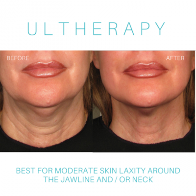 Ultherapy Jawline Contour Ultherapy Jawline Contour
