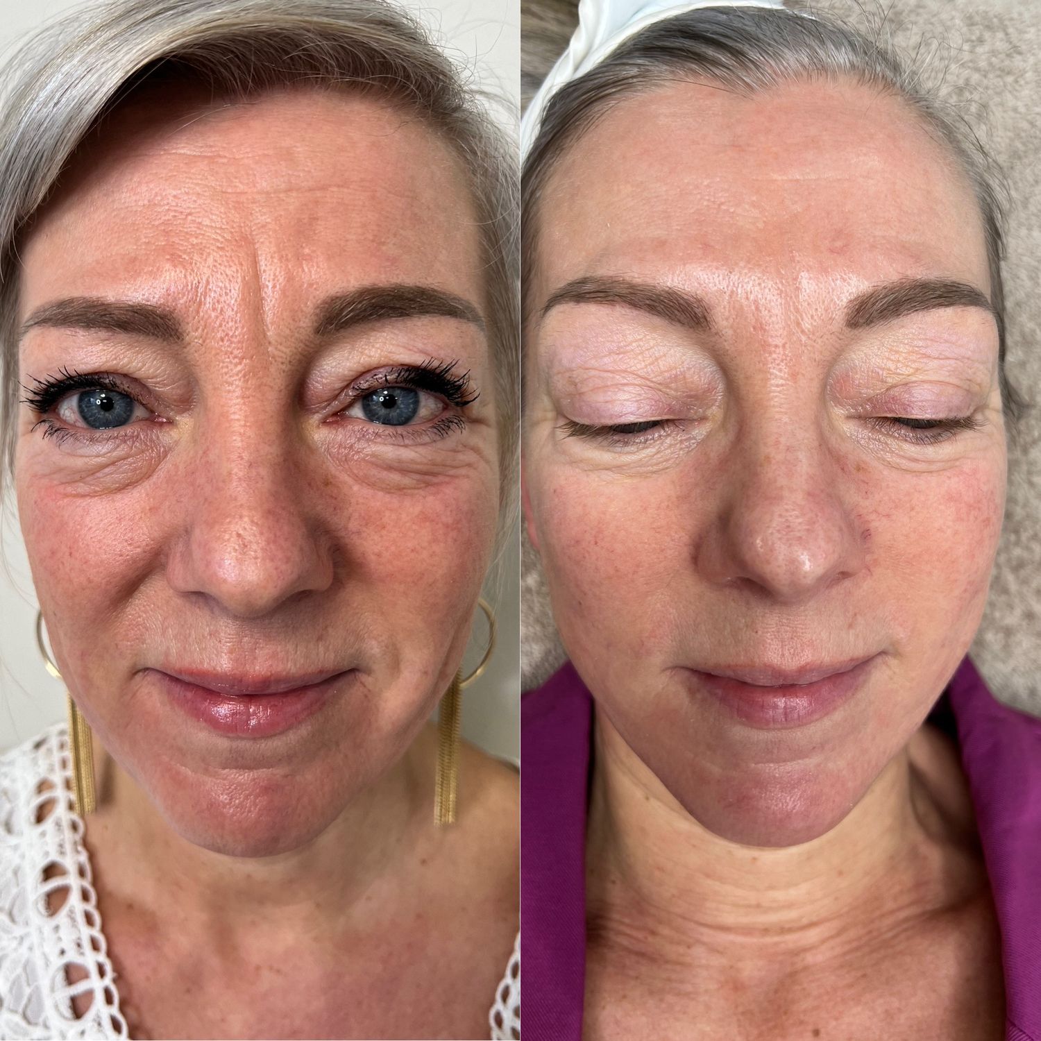 SKINPEN - Microneedling voor een diep anti-aging effect en zoveel meer! (MAX 50 beschikbaar)