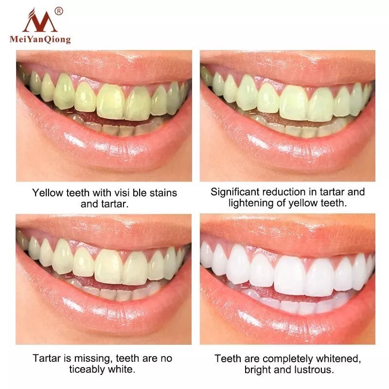 Blanqueamiento dental 