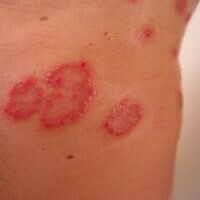 牛皮癣 | Psoriasis
