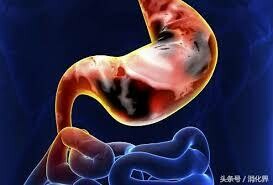 胃潰瘍 | Gastric Ulcer