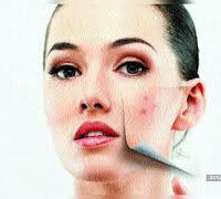 嚴重暗瘡 | Severe Acne