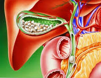 膽結石 | Gallstone
