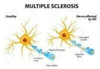 多發性硬化症 | Multiple Sclerosis