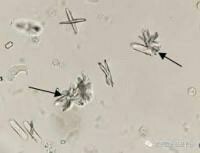 焦磷酸鈣結晶 | Crystallization Of Calcium Pyrophosphate