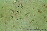 草酸鈣結晶 | Calcium Oxalate Crystal
