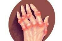 類風濕性關節炎 | Rheumatoid Arthritis (RA)