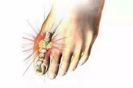 尿酸關節痛 | Uric Acid Arthralgia