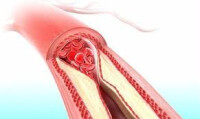 尿酸冠狀動脈鈣化 | Uric Acid Coronary Calcification