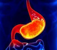 十二指腸潰瘍 | Duodenal Ulcer