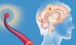 糖尿血管神經病 | Diabetic Vascular Neuropathy