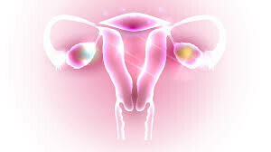 子宮內膜異位 | Endometriosis