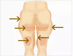 腰、臀、腿-定位溶脂 | Waist, Hip, Thigh-Positioning Lipolysis
