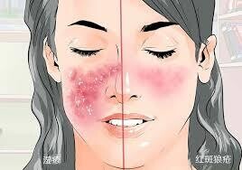 系統性紅斑狼瘡 | Systemic Lupus Erythematosus (SLE)