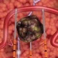 納米刀資訊 | NanoKnife Information