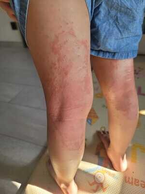 濕疹: 8歲妹妹 | Eczema: Eight-Year-Old Girl