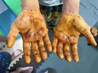 女士雙手嚴重濕疹 | Woman With Severe Eczema On Both Hands