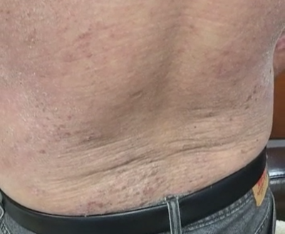 男士全身嚴重濕疹 | Man With Severe Eczema On Whole Body