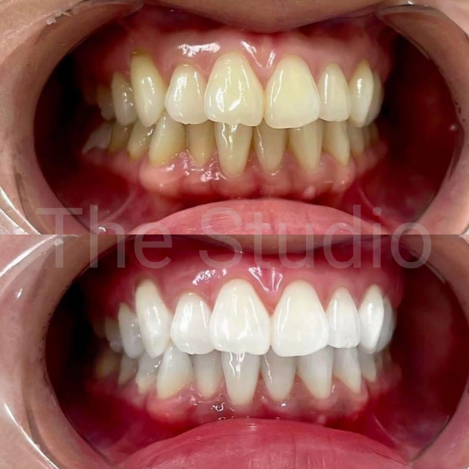 Hollywood Teeth Whitening - Introductory Price - 3 Sessions 