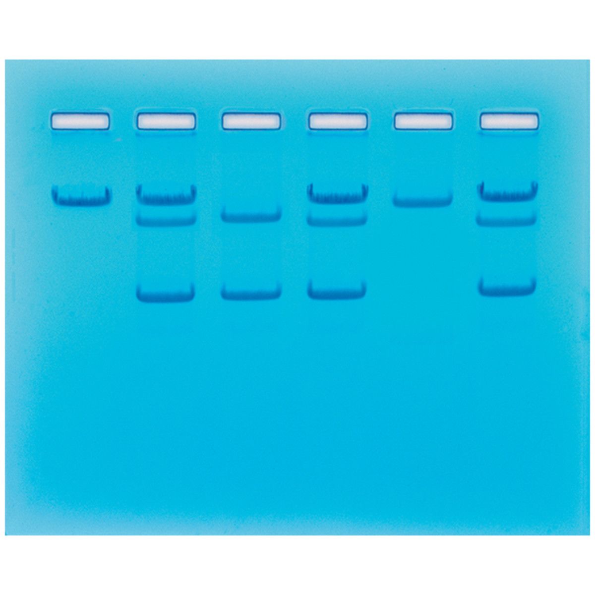 Sickle Cell Gene Detection (DNA-based)