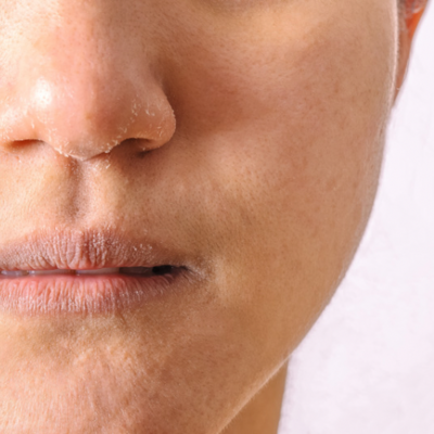 Dehydrated Skin Plans