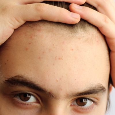 Oily or Congested Skin Plans