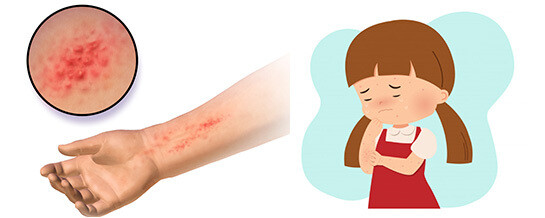 Braude&#39;s Toddler (2 years and up) Dry Eczema Pack