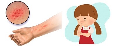 Braude&#39;s Toddler (2 years and up) Dry Eczema Pack