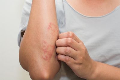 Eczema &amp; Allergic Dermatitis