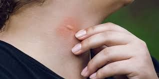 Insect bites, itchy skin, hives, sunburn &amp; allergy rashes