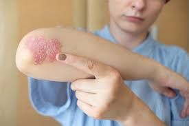 Psoriasis &amp; very dry skin conditions