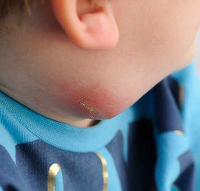 Insect stings, splinters &amp; boils, absesses