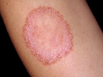 Fungal body conditions
