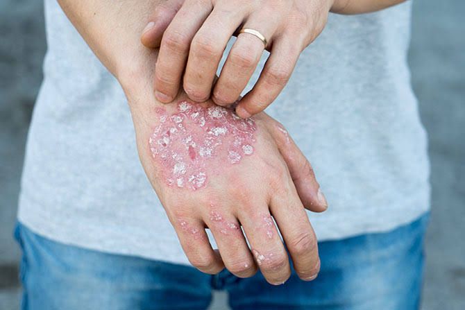Psoriasis ointments (fridge-line)