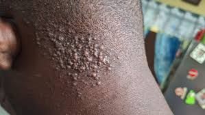 Braude's Barbers rash 30g
