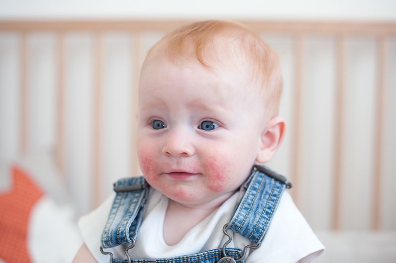 Braude's Infant (6 months &amp; up) Dry Eczema Pack