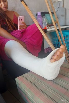 Nilda Medical LLC - VIDEO 01: Weeks 1-2 in cast