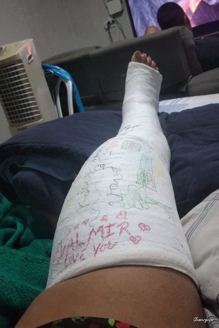 Nilda Medical LLC - VIDEO 03: Weeks 5-6 in cast