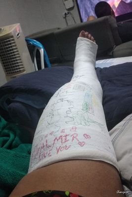Nilda Medical LLC - VIDEO 04: Weeks 7-8 in cast