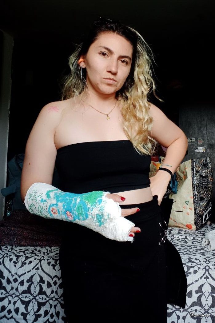 Paula Medical SAFS - VIDEO 08: Eighth week in medical cast