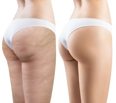 The Cellulite Package